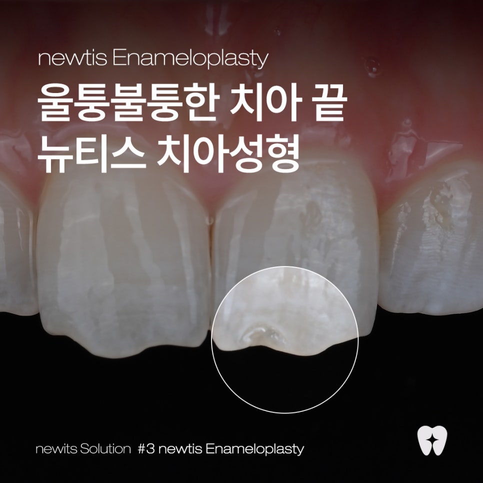 뉴티스 치아성형✨ 살짝 깨진 앞니, 뾰족한 송곳니 다듬기 / 강남레옹치과 관련 이미지 1