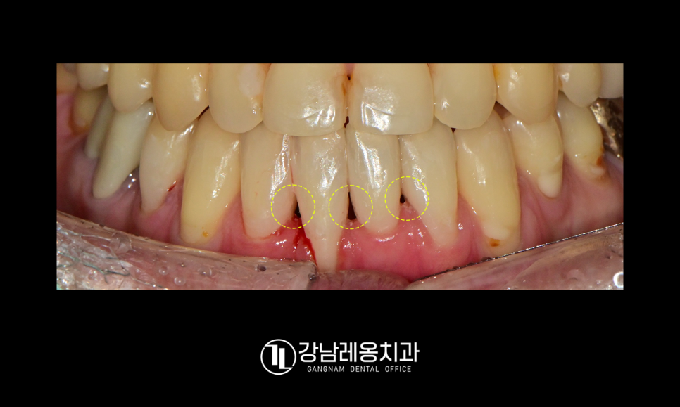 잇몸과 치아 사이 공간 &lsquo;블랙트라이앵글&rsquo;을 무시하면 안되는 이유! / 생기는 원인과 해결 방법 / 강남레옹치과 관련 이미지 5