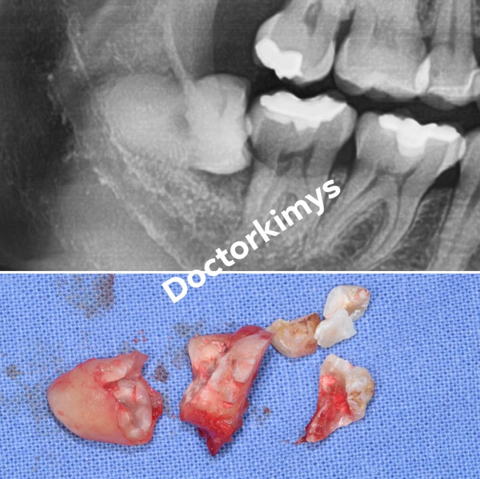 치과의사도 뽑으러 오는 사랑니 발치 전문 강남레옹치과! 관련 이미지 3