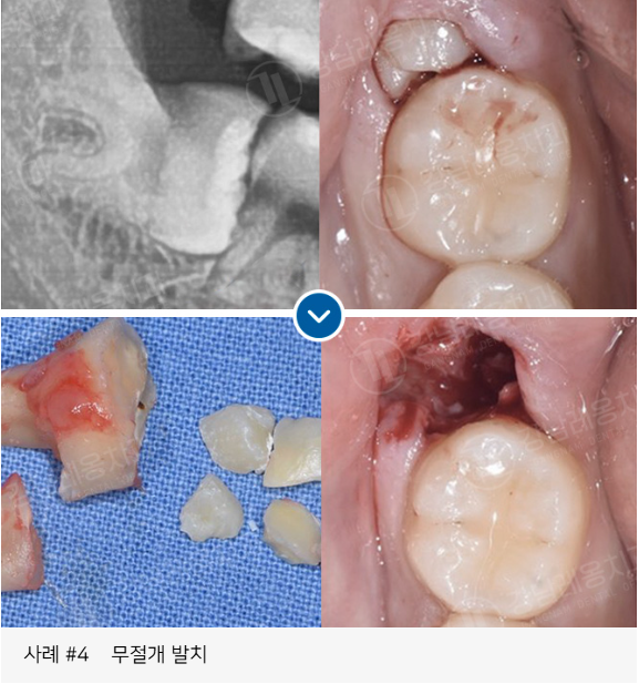 사랑니 발치, 왜 어떤 경우에 대학병원을 권유할까? / 강남레옹치과 관련 이미지 12