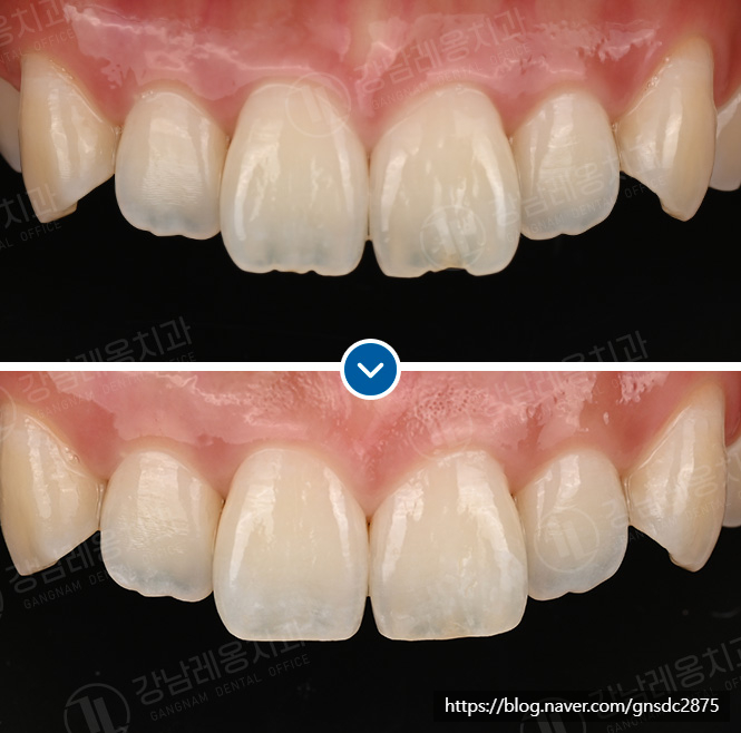 뉴티스 치아성형✨ 살짝 깨진 앞니, 뾰족한 송곳니 다듬기 / 강남레옹치과 관련 이미지 2
