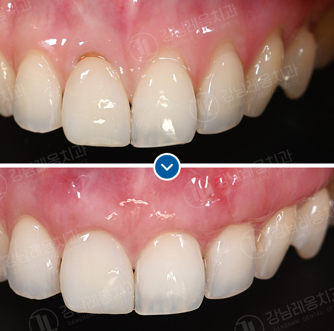 박영민 원장님의 뉴티스 앞니치료 세미나 in LA🤓 관련 이미지 3