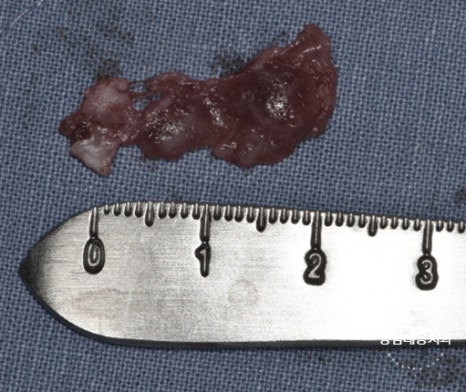 사랑니 발치, 왜 어떤 경우에 대학병원을 권유할까? / 강남레옹치과 관련 이미지 8