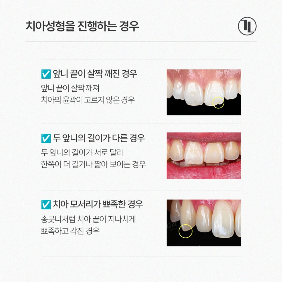살짝 깨진 앞니 끝, 치아성형으로 고르게 다듬기 / 강남레옹치과 관련 이미지 3
