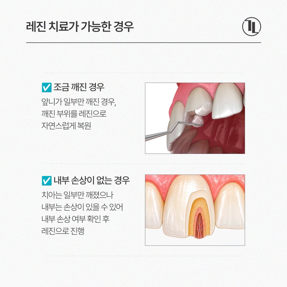 앞니 깨짐 레진치료 가능한 경우 / 레진치료 사례와 과정 / 강남레옹치과 관련 이미지 2