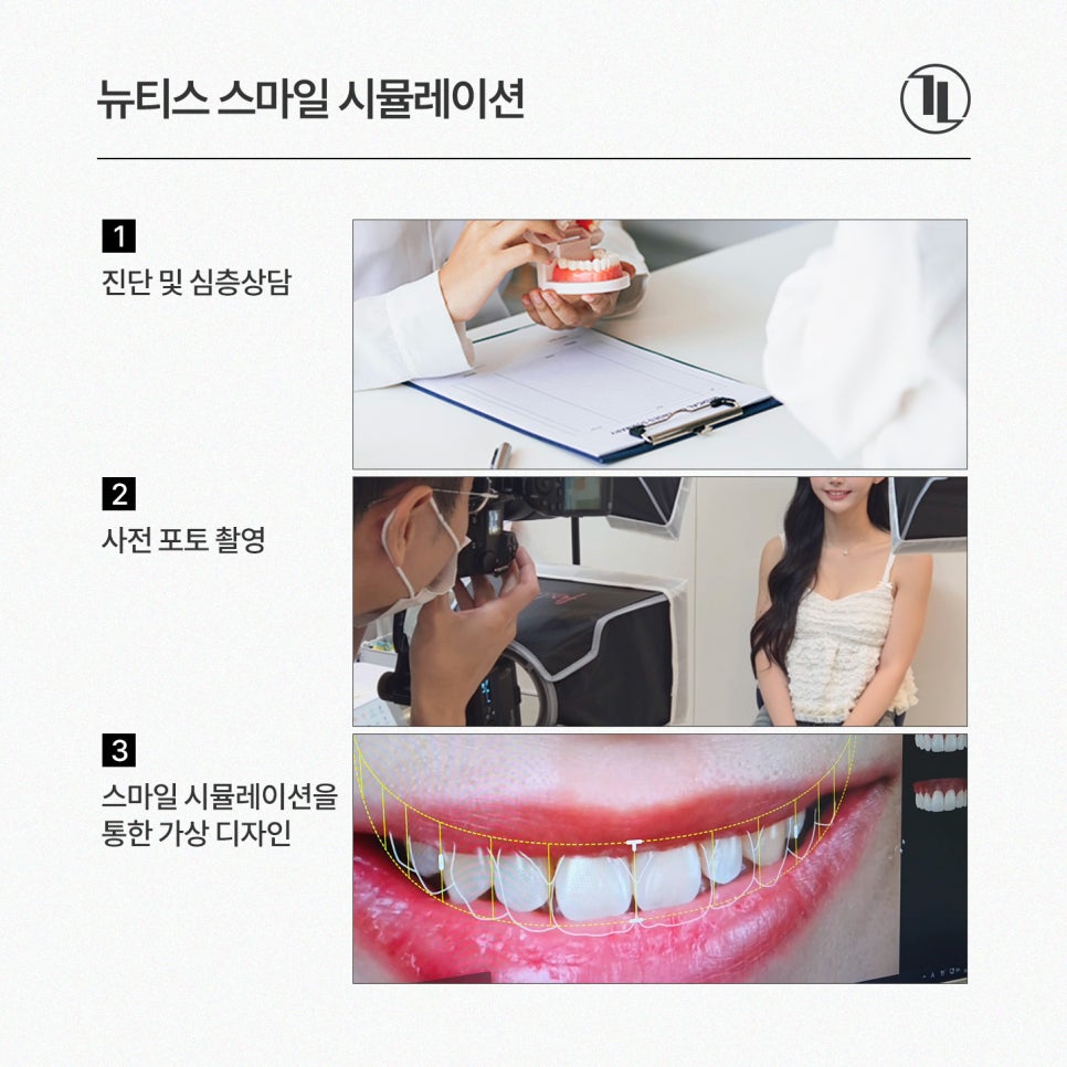 뉴티스 스마일 시뮬레이션 - 시술 전 영상으로 미리 확인하는 내 모습! / 강남레옹치과 관련 이미지 4