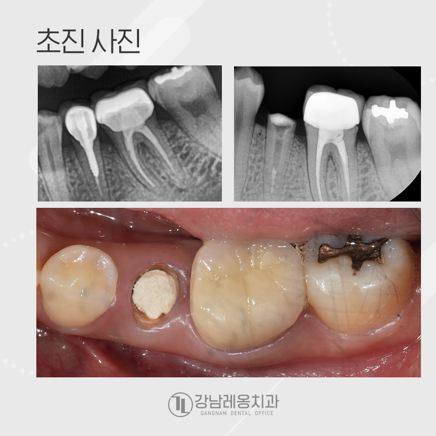 뿌리만 남은 치아, 발치 즉시 임플란트 케이스 관련 이미지 2