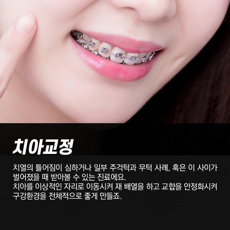 치아교정, 라미네이트 장단점과 차이점을 명확하게 알자! 관련 이미지 4