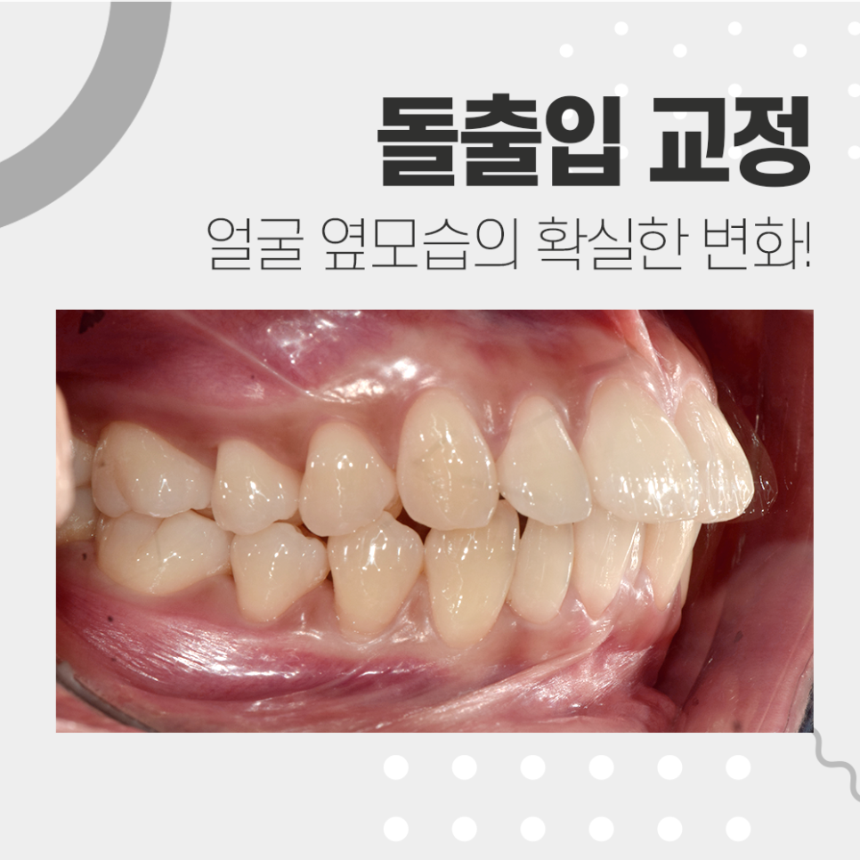 강남레옹치과 치아 교정, 돌출입 두가지 케이스 관련 이미지 5