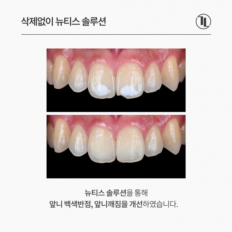 깨지고 하얗게 얼룩진 앞니, 라미네이트 대신 뉴티스 솔루션 / 강남레옹치과 관련 이미지 6