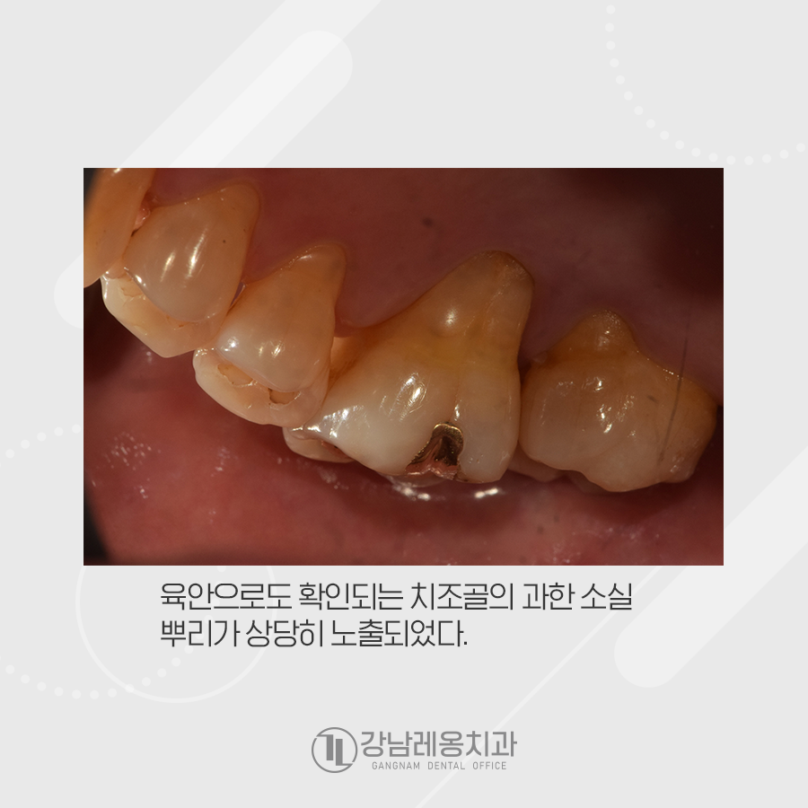 치주질환이 심하여 발치를 한 뒤 임플란트수술 관련 이미지 2