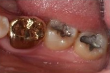 사랑니 발치 후 회복과정 한 눈에 보기🔍 / 강남역 사랑니 강남레옹치과 관련 이미지 3