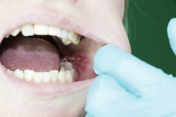 사랑니 통증, 약 먹으며 방치하면 안되는 이유! 실제 방치 사례🔍 / 강남레옹치과 관련 이미지 2