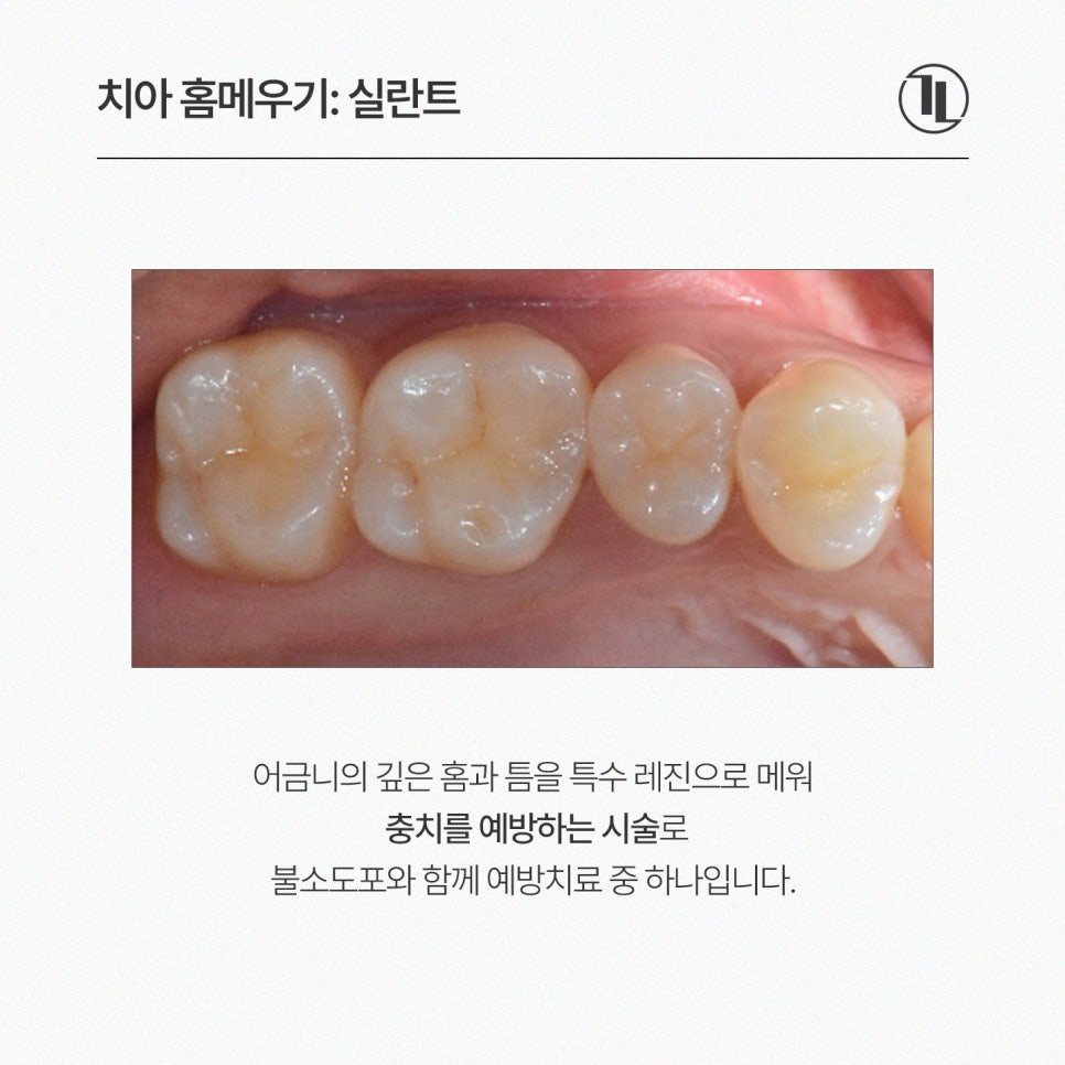 아이 충치 예방 치아 홈메우기 총정리! 실란트 시기&middot;비용(보험적용)&middot;효과 완벽 가이드 / 강남레옹치과 관련 이미지 2