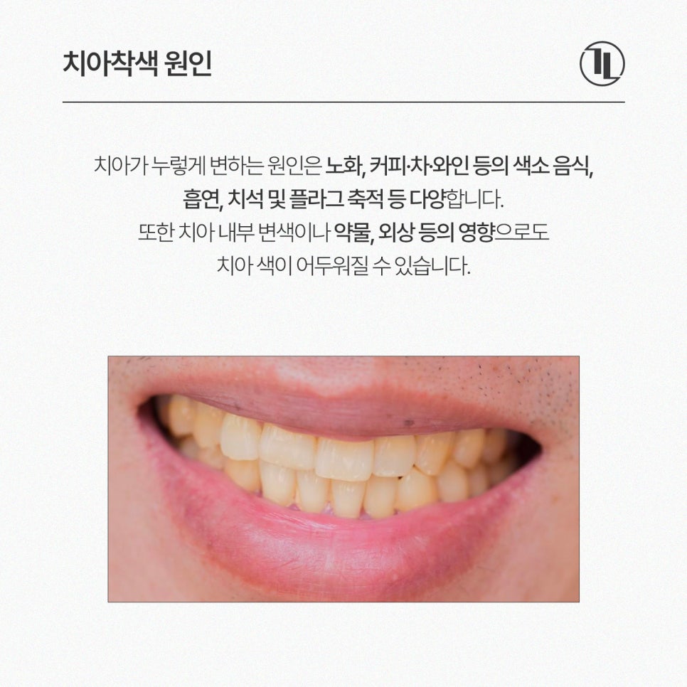 치아미백 가이드 / 비용과 효과, 셀프 미백 비교까지 / 강남레옹치과 관련 이미지 2
