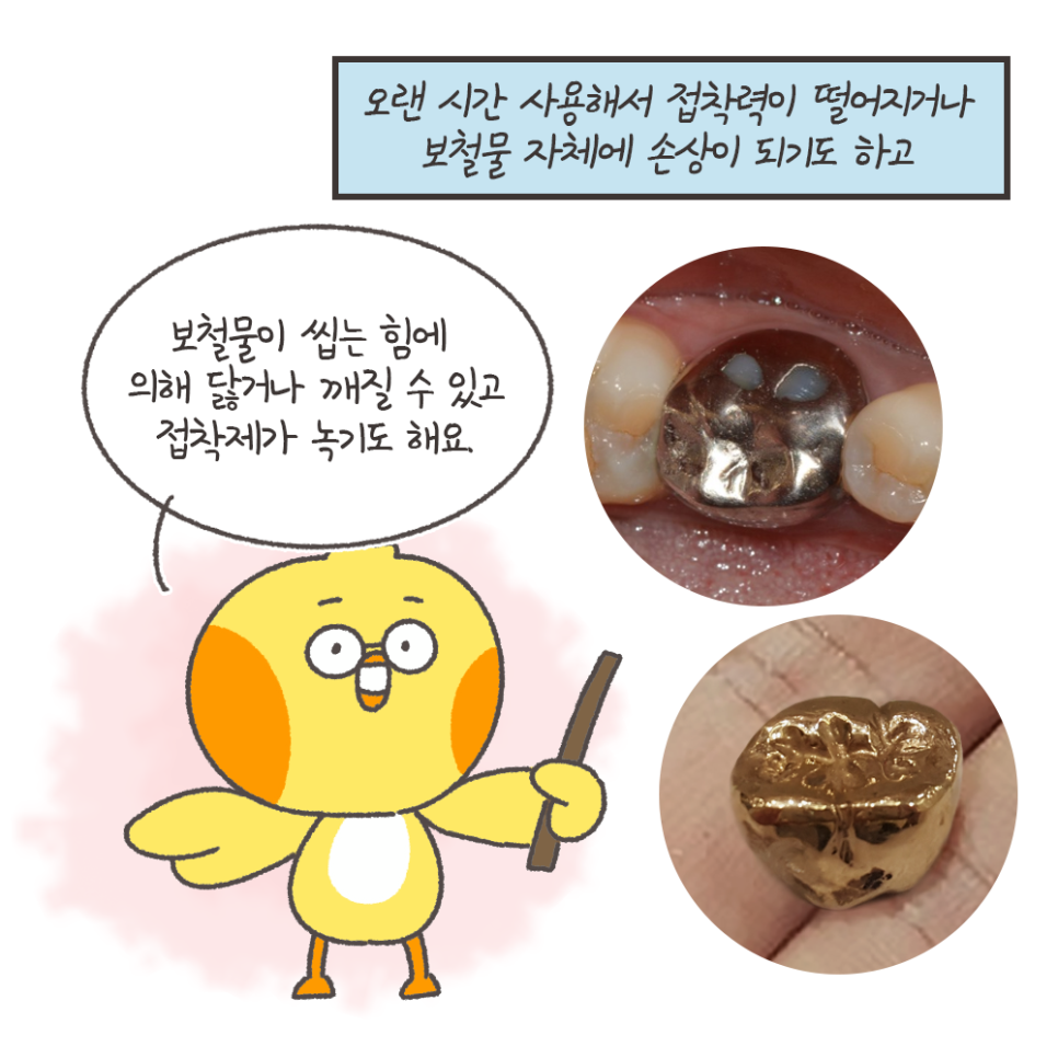 떨어진 금니 다시 붙일 수 있을까? - 보철물 탈락 이유, 대처법 (냐폴레옹 치과툰) 관련 이미지 7