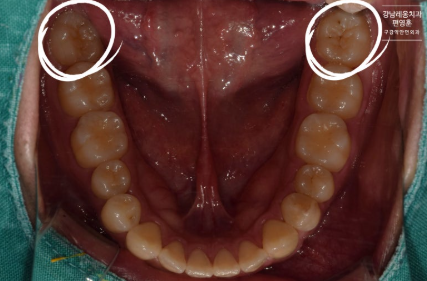 사랑니 통증, 약 먹으며 방치하면 안되는 이유! 실제 방치 사례🔍 / 강남레옹치과 관련 이미지 4
