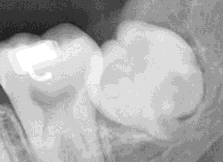 강남레옹치과 사랑니 발치 전문! 아프기 전에 미리 뽑아주세요! 관련 이미지 5