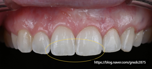 뉴티스 잇몸성형✨ 거미스마일 원인과 해결법, 잇몸성형으로 가능한가요? / 강남레옹치과 관련 이미지 4