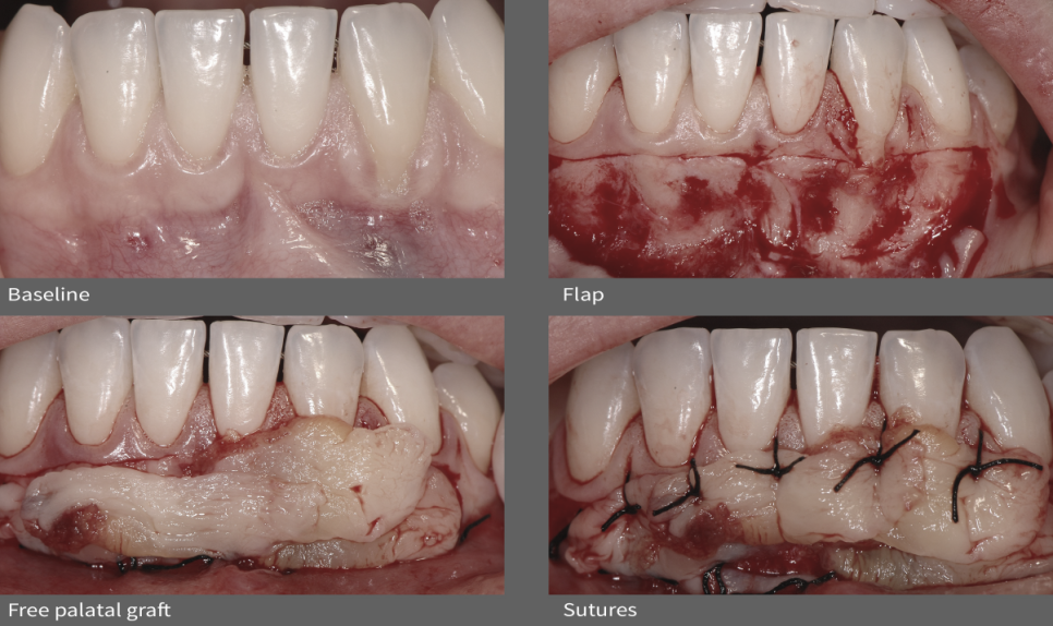박영민 원장님의 논문! 치은이식 후 자연치아 주위 잇몸퇴축 감소에 관한 연구 관련 이미지 3