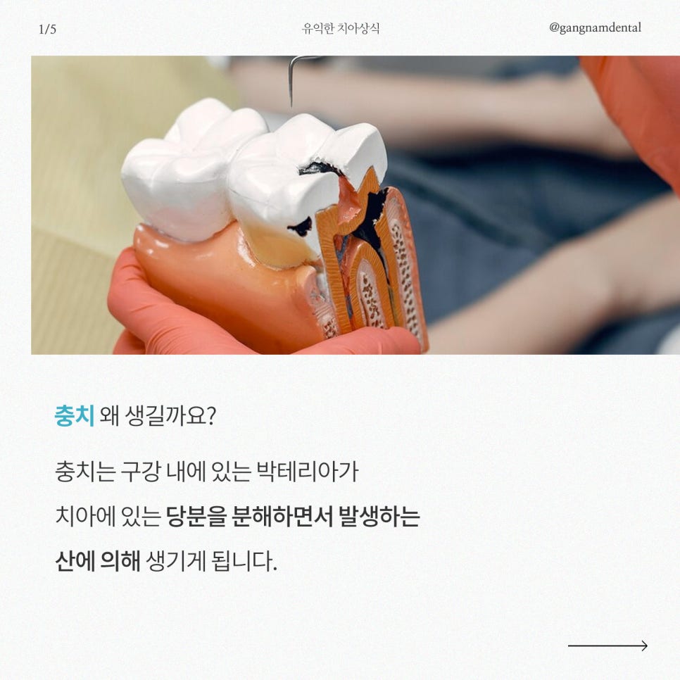 강남레옹치과에서 알려드리는 충치가 생기는 의외의 이유! 관련 이미지 2