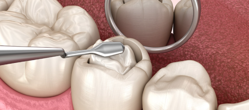 찬물 이시림 증상 원인과 치료, 시린 치아 관리 가이드🔖 / 강남레옹치과 관련 이미지 3