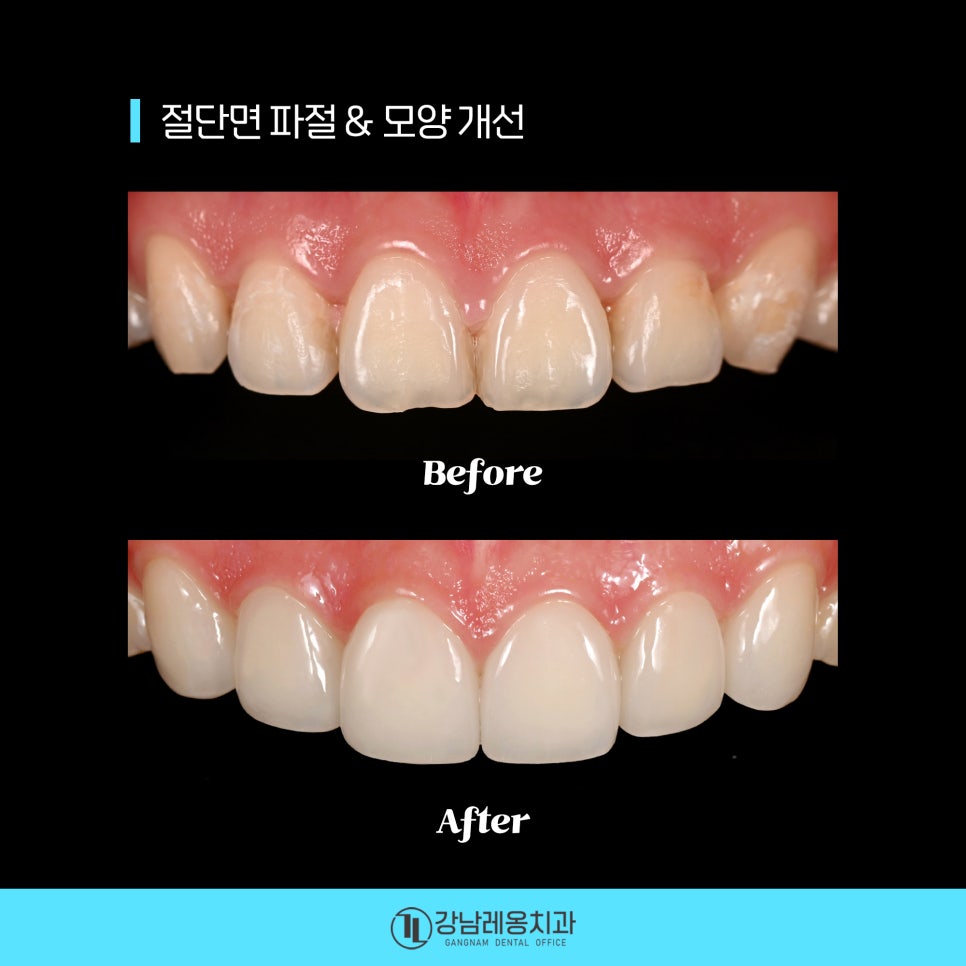 최소삭제 라미네이트 &lsquo;뉴티스&rsquo;의 시술 후 관리방법은? / 양치질, 치실 사용방법 / 강남레옹치과 관련 이미지 1