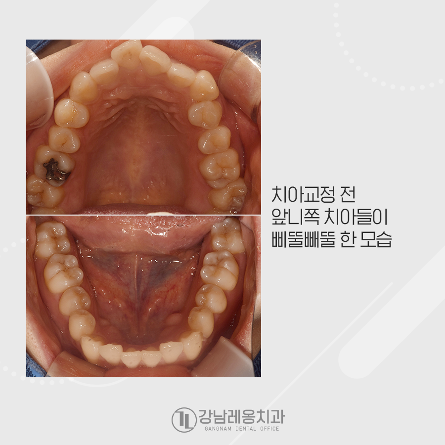 삐뚤빼뚤 앞니 비발치 교정, 옥니가 되지 않게 관련 이미지 2