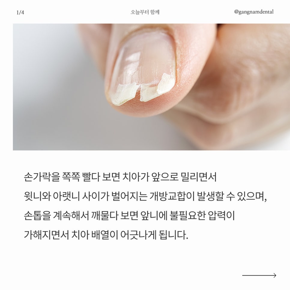 부정교합을 유발하는 생활습관이 있다고? / 부정교합으로 인한 턱관절 장애까지? / 치아교정치과 / 강남레옹치과 관련 이미지 2