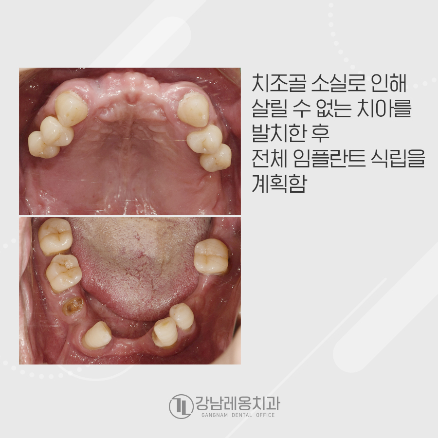 강남레옹치과 전악 임플란트 수술로 심미, 저작 기능을 회복해요. 관련 이미지 3