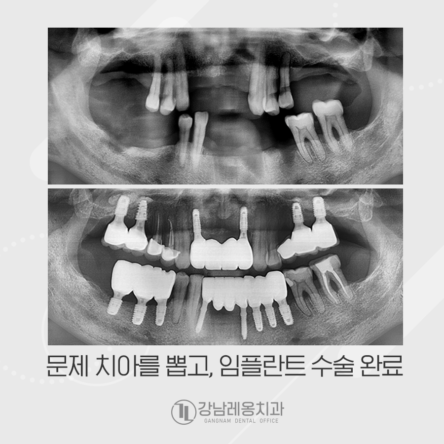 강남레옹치과 전악 임플란트 수술로 심미, 저작 기능을 회복해요. 관련 이미지 4