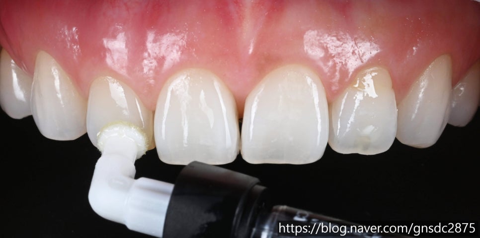 뉴티스 반점치 치료✨ 최다 임상적용, 반점치 제거 아이콘레진 / 강남레옹치과 관련 이미지 3