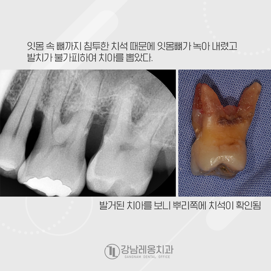 치주질환이 심하여 발치를 한 뒤 임플란트수술 관련 이미지 3