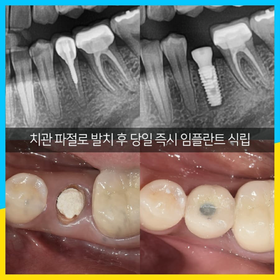 오래 방치했던 치아들 결국 임플란트 수술 관련 이미지 4