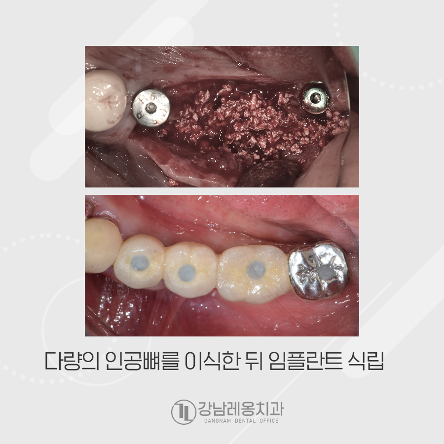 멀쩡한 줄 알았던 오래된 브릿지, 임플란트 수술한 사연 관련 이미지 4