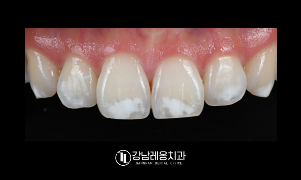 앞니 하얀점, 앞니 반점치 삭제없이 치료! / 아이콘 레진 치료 / 강남레옹치과 관련 이미지 3