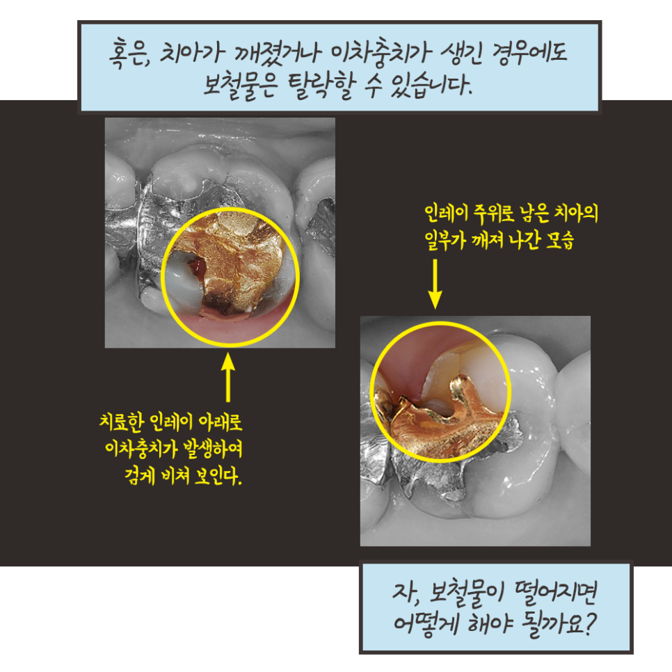 떨어진 금니 다시 붙일 수 있을까? - 보철물 탈락 이유, 대처법 (냐폴레옹 치과툰) 관련 이미지 8