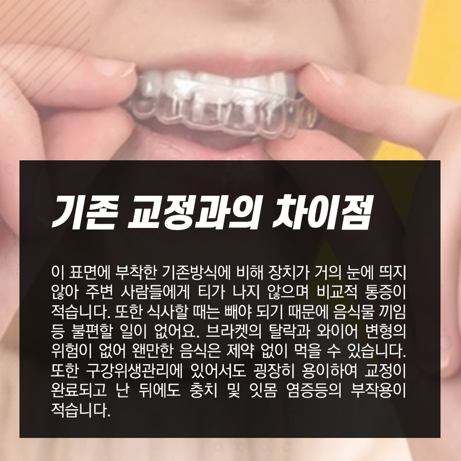 강남레옹치과 티 안나게 부정교합 변화를?! 투명교정 장단점에 관하여 관련 이미지 3