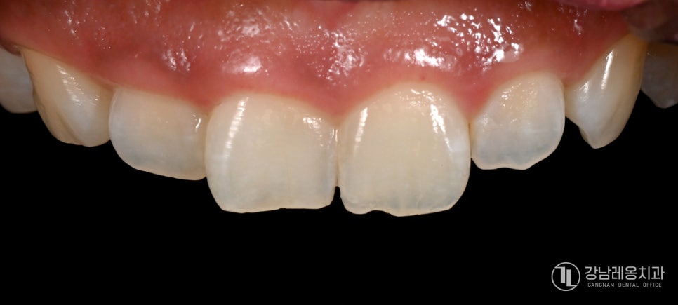 앞니 끝이 살짝 깨졌다면? 뉴티스 치아성형으로 자연스럽게 치아라인 정리하기 관련 이미지 2