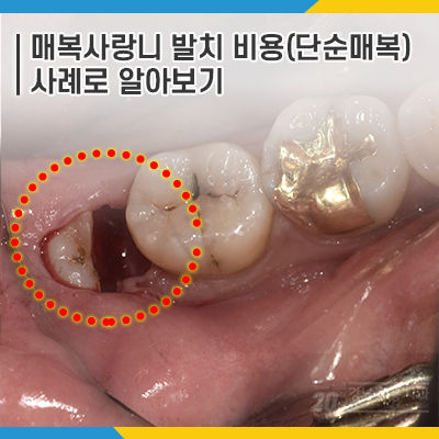 매복 사랑니발치 비용, 강남레옹치과 증례를 보며 알아봐요. 관련 이미지 1
