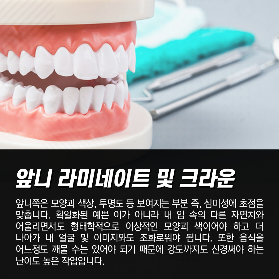앞니 라미네이트 올세라믹 크라운 가격. 왜 어금니보다 비싼가?? 관련 이미지 4