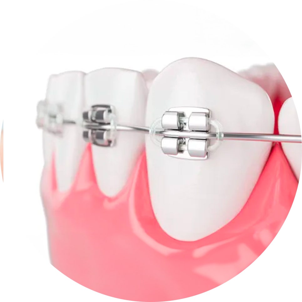 치아교정 종류와 선택법 & 관리 꿀팁 5가지!🖐️ / 강남레옹치과 관련 이미지 4