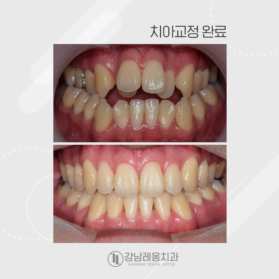 앞니가 물리지 않는 개방교합과 주걱턱을 치아교정으로 한번에..? 관련 이미지 5