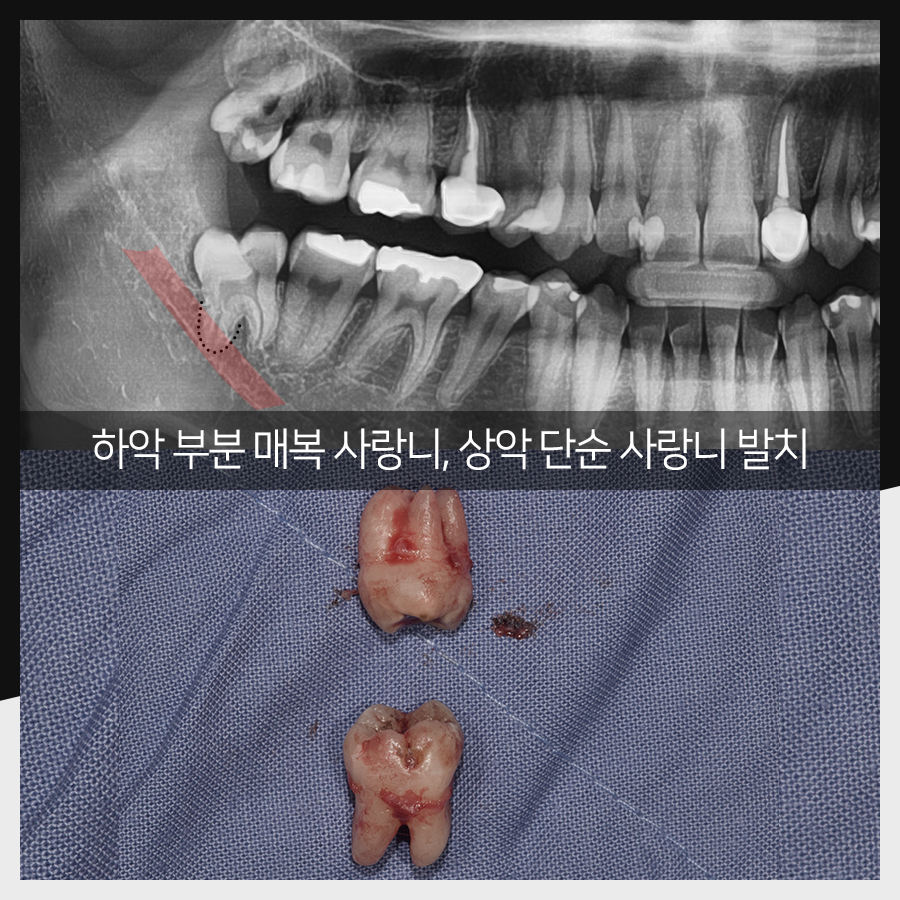 강남레옹치과 사랑니 발치, 결과가 증명해주는 실력! 관련 이미지 18