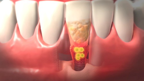 사랑니 통증, 약 먹으며 방치하면 안되는 이유! 실제 방치 사례🔍 / 강남레옹치과 관련 이미지 3