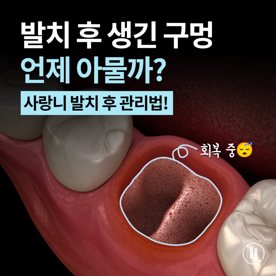 사랑니 발치 후 구멍, 음식물 끼임부터 회복, 관리법까지 총정리📑 / 강남레옹치과 관련 이미지 1