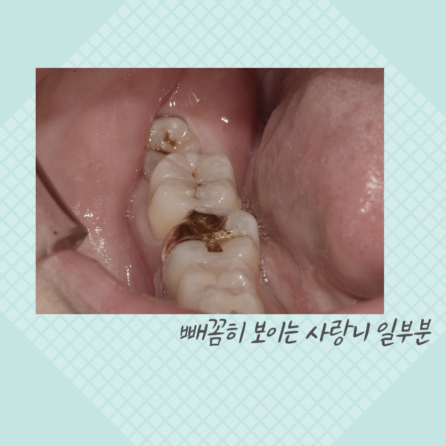 매복 사랑니발치 비용, 강남레옹치과 증례를 보며 알아봐요. 관련 이미지 2