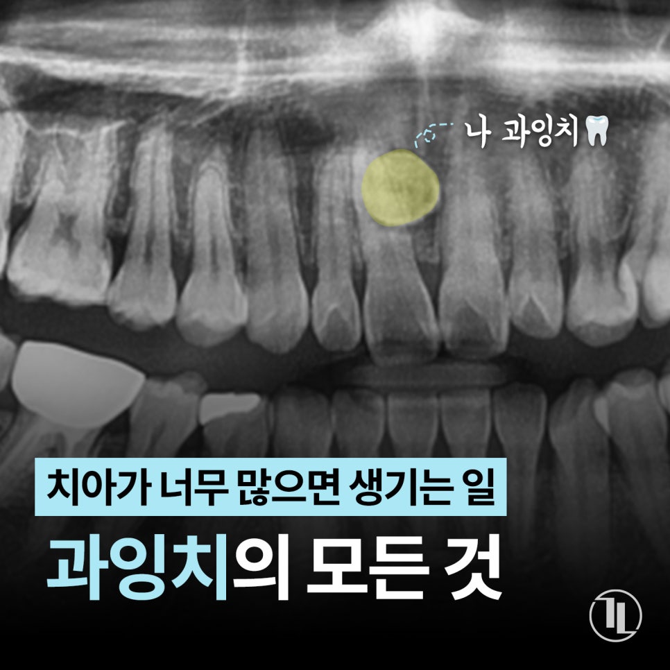 치아가 너무 많으면 생기는 일, 과잉치의 모든 것🦷 / 강남레옹치과 관련 이미지 1