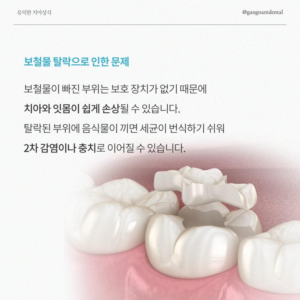 보철물탈락 대처방법은? / 추석명절 생긴 치아 문제, 계속 방치하지 마세요! / 강남레옹치과 관련 이미지 3