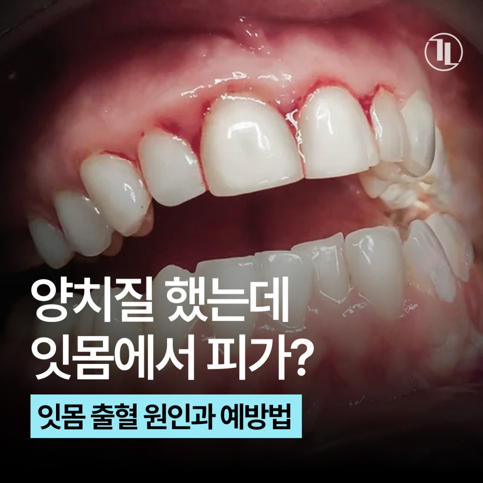 잇몸에서 피나는 사람들의 공통된 습관 4가지? / 잇몸 피 예방법 / 강남레옹치과 관련 이미지 1